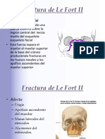 Fracturas faciales Le Fort II y III