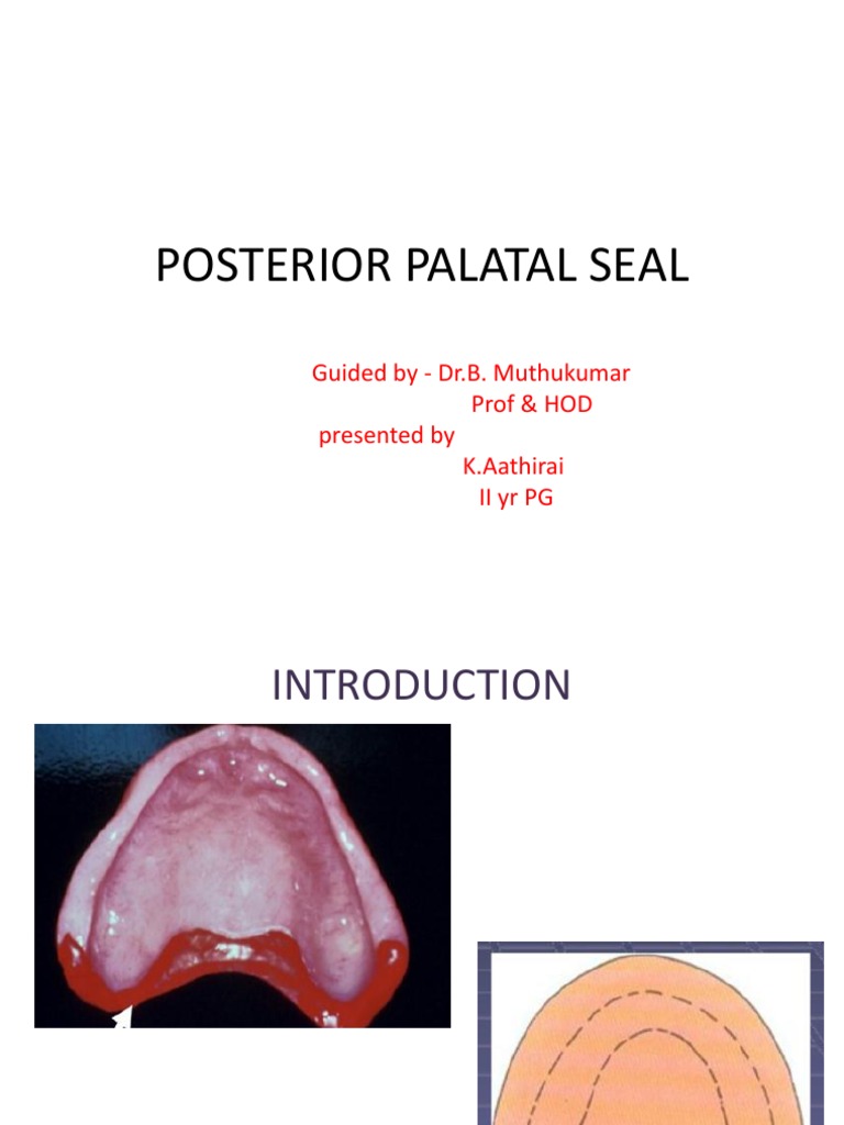 Posterior Palatal Seal