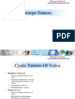 Benign Tumors