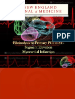 Fibrinolysis or Primary PCI in ST-Segment Elevation Myocardial Infarction