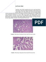 Histopatologi Hiperplasia Prostat Jinak Dan CCS