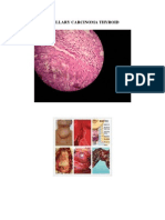 Download Papillary Carcinoma Thyroid by William Bunga Datu SN153720570 doc pdf