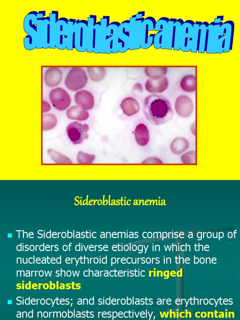 Sideroblastic Anemia Bone Marrow Anemia