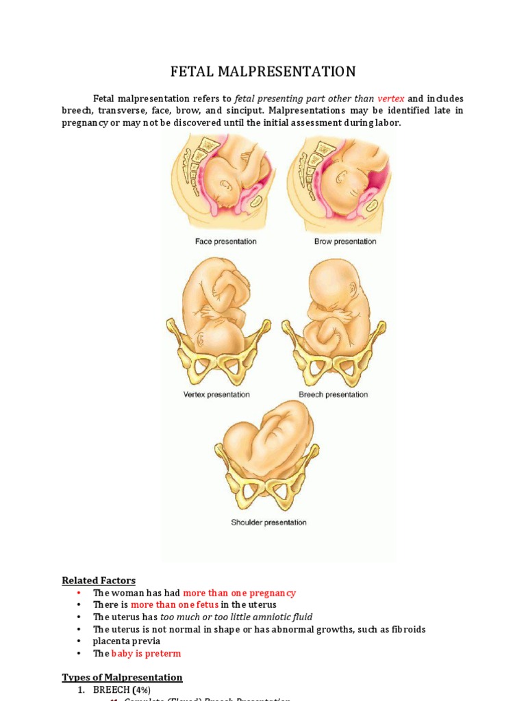 definition malpresentation fetus