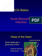 ECG Basics: Acute Myocardial Infarction
