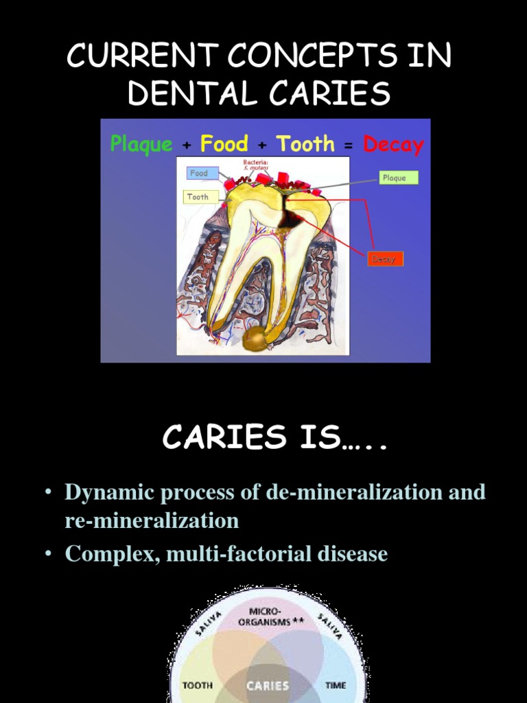 Current Concepts in Etiology of Caries Chemistry Foods
