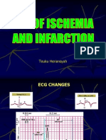 ECG, Ischemia,MCI (Rev)