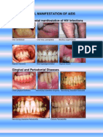Oral and Periodontal Manifestation of HIV Infections