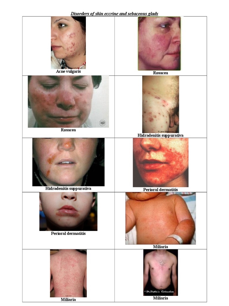 Disorders of Skin Eccrine and Sebaceous Glads | PDF