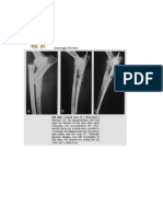 Monteggia Fracture Dislocation X-Ray