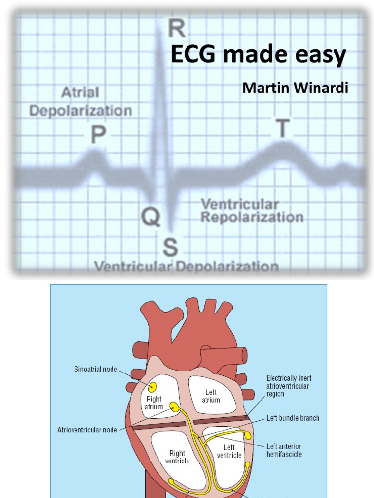 Understanding EKG: Key Criteria and Patterns | PDF