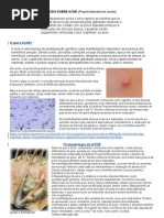 Tudo Sobre Acne