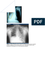 Pneumonia: Figure 1. Diffuse Bilateral Air-Space Opacities Consistent With Pneumonia. Possible
