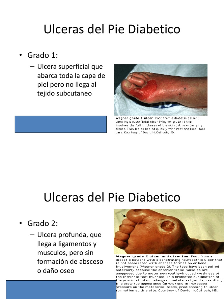 Ulceras Del Pie Diabetico