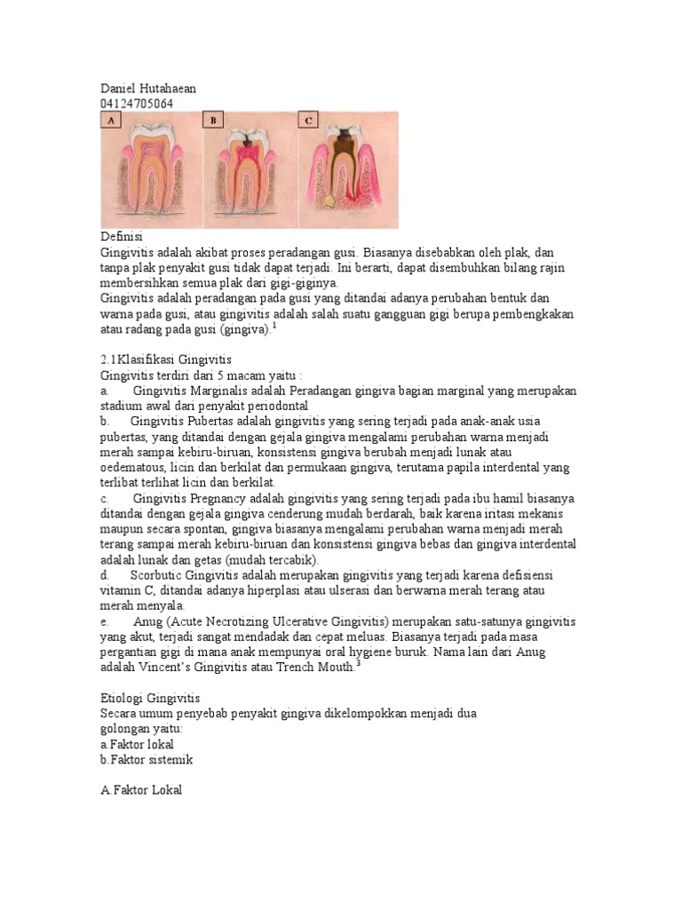 Gingivitis | PDF