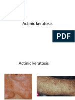 Actinic Keratosis