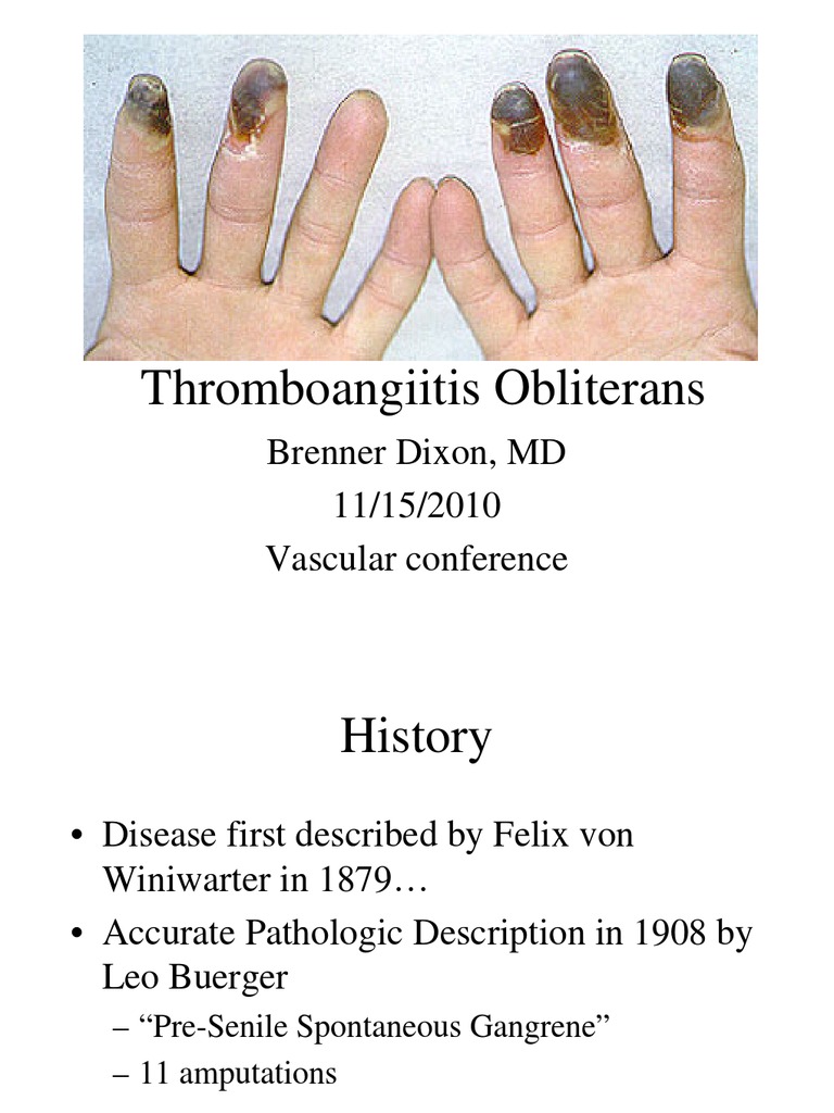Thromboangiitis Obliterans Angiology Vascular Diseases