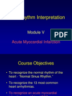 Ecg Changes in Acute Myocardial Infarction