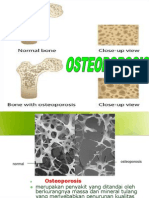 Osteoporosis 