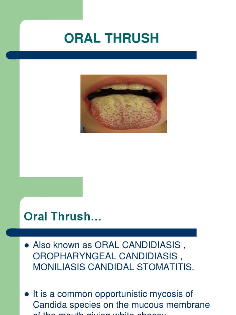 Oral Thrush PDF Candidiasis Medical Specialties