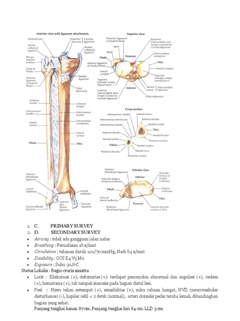 Frakture Tibia Fibula | PDF