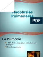 Neoplasias Pulmonares