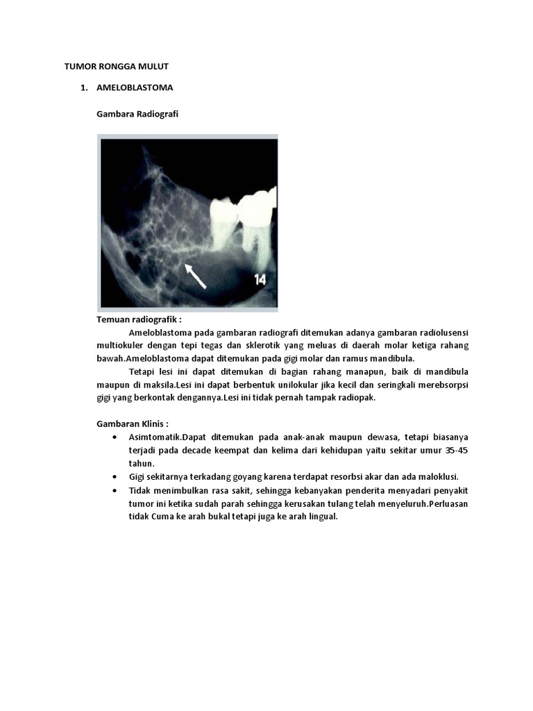 Tumor Rongga Mulut