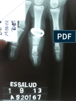 Lesión de dedo por anillo - Presentación de un caso
