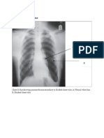 Open Pneumothoraxx