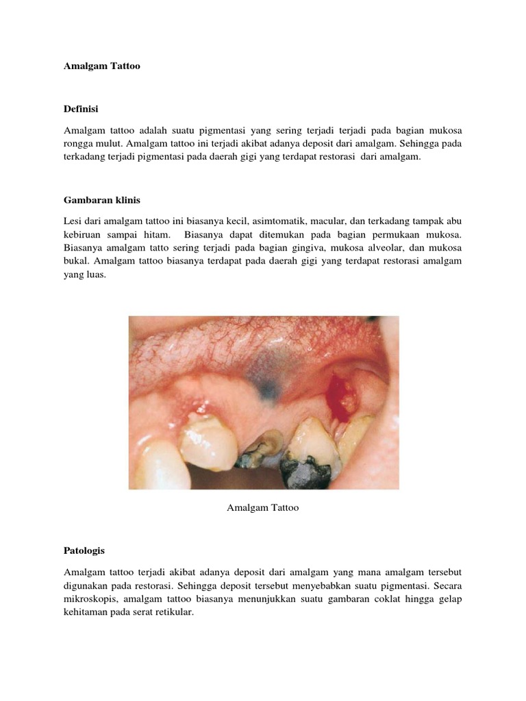 Amalgam Tattoo PDF