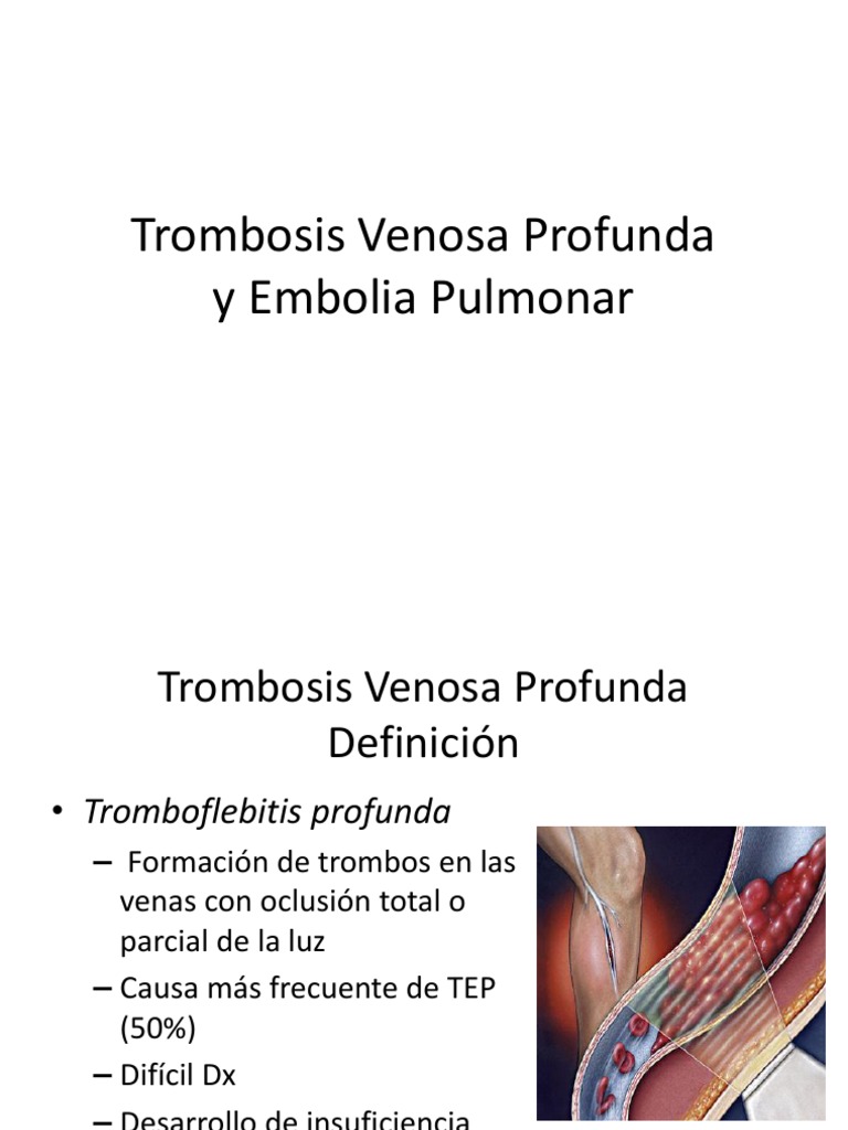 Trombosis Venosa Profunda