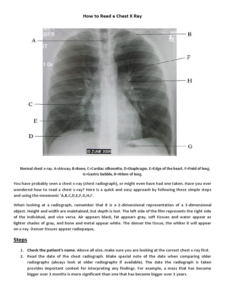 How to Read a Chest X Ray Lung Anatomy