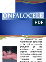 ONFALOCELE