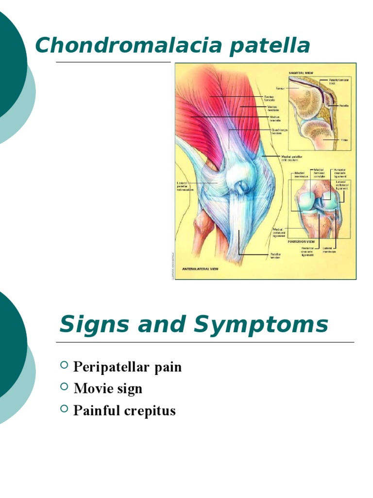 Chondromalacia Patella