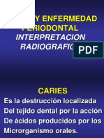 Caries y Enfermedad Periodontal