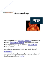 Anencephaly