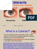 81653907-CataractDV