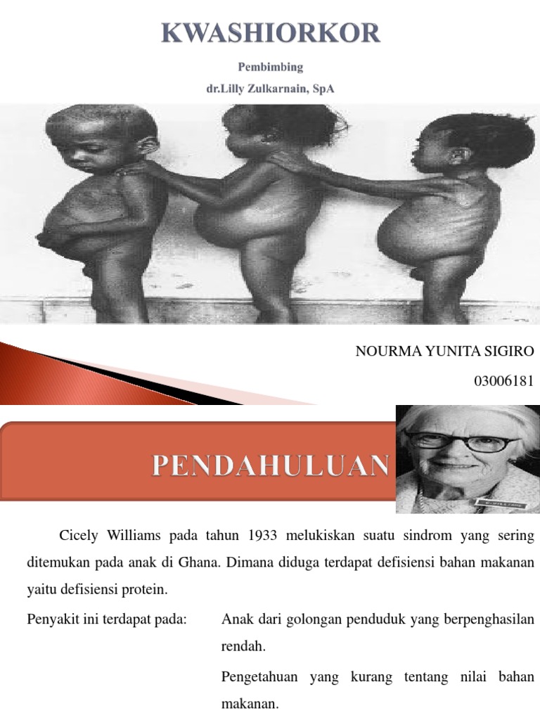 KWASHIORKOR PPT