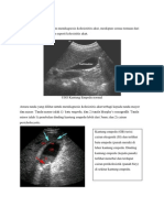 Acute Cholecystitis