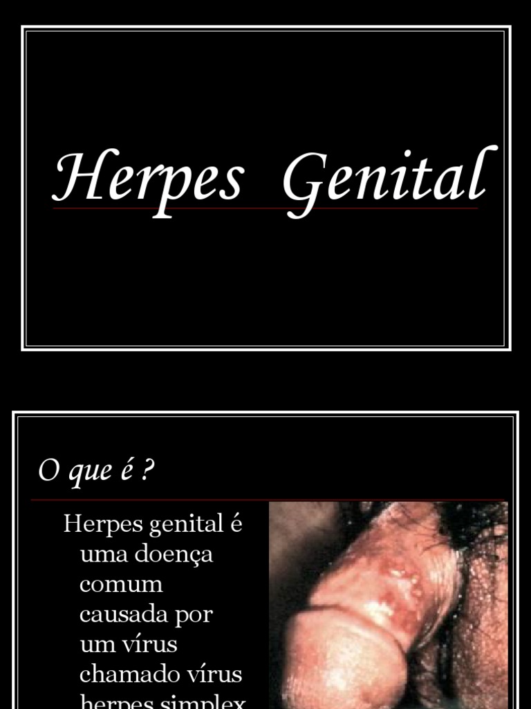 Herpes Genital | PDF | Herpes simples | Relação sexual, image size:768x1024