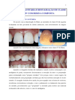 Adequacao Cavitaria e Restauracao de Classe III e IV Com Resina Composta