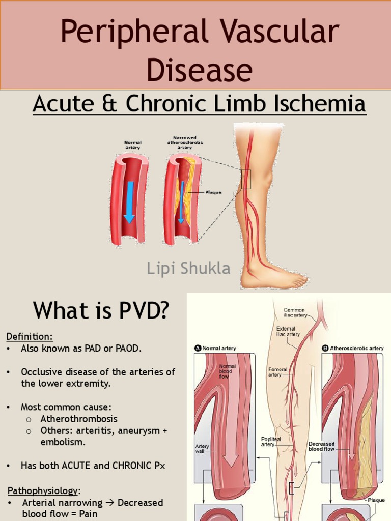 Peripheral Vascular Disease Surgical Presentation | Ischemia | Angiology