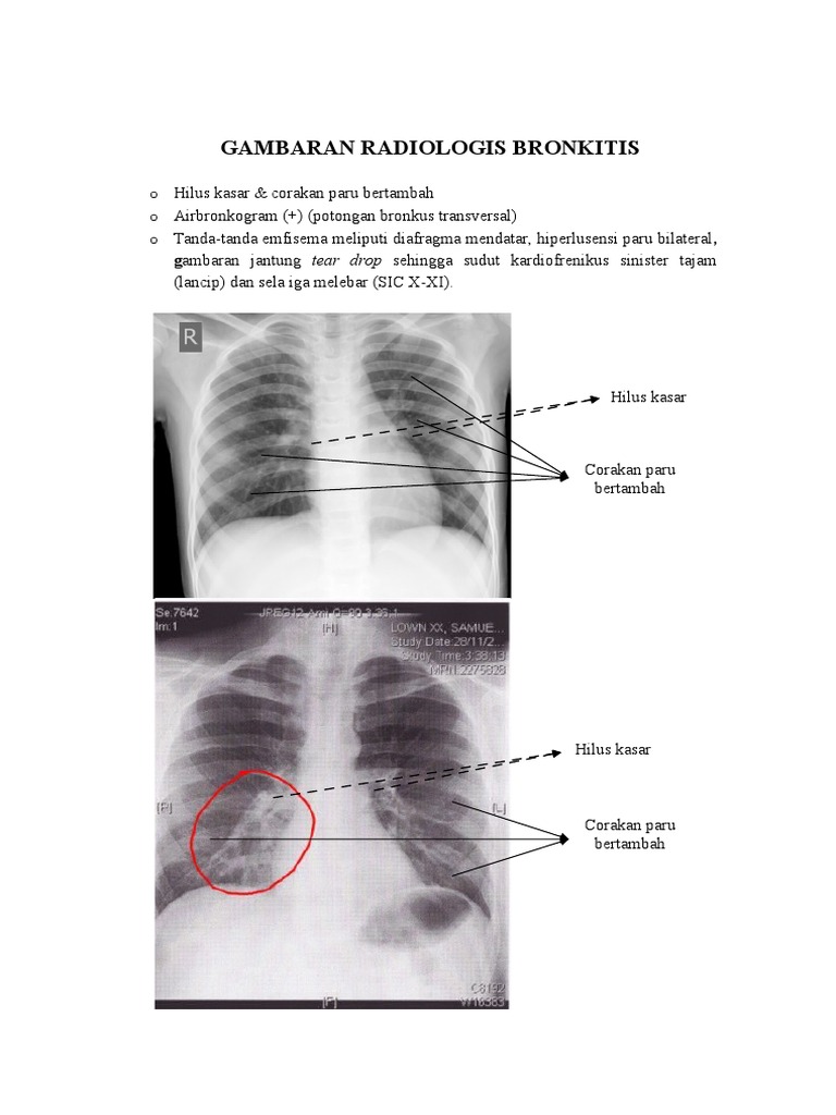 Ringkasan Bronkitis - 2 | PDF