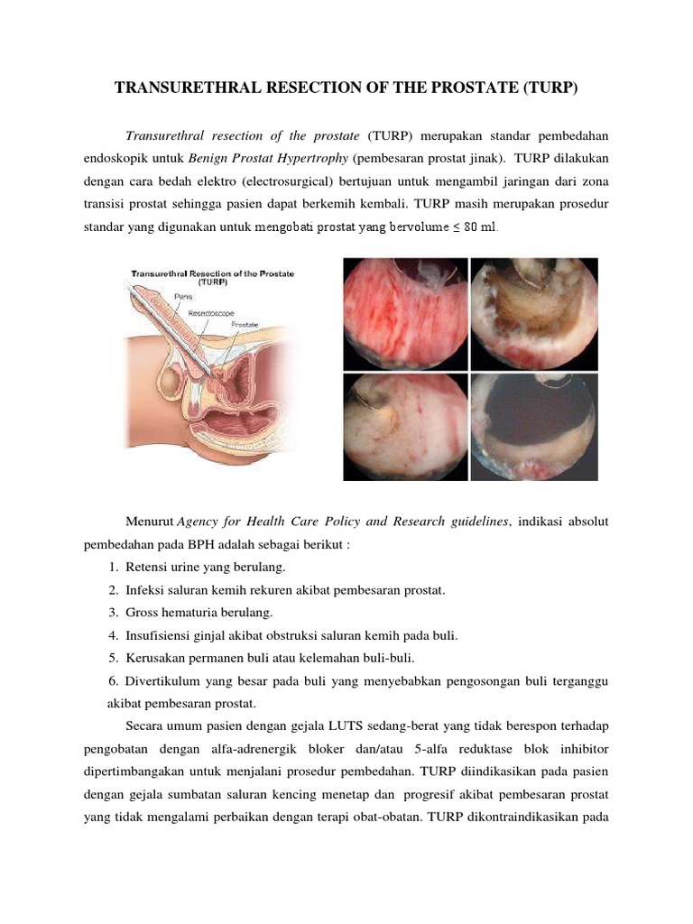 Transurethral Resection of The Prostate | PDF | Pengembangan Diri