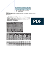 TAQUIARRITMIAS
