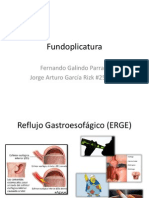 Fundoplicatura