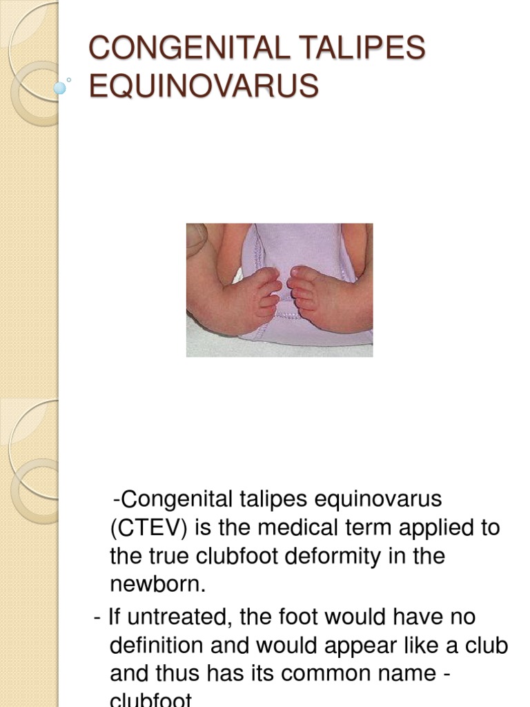 CONGENITAL TALIPES EQUINOVARUS.pptx Trastorno congénito Pie