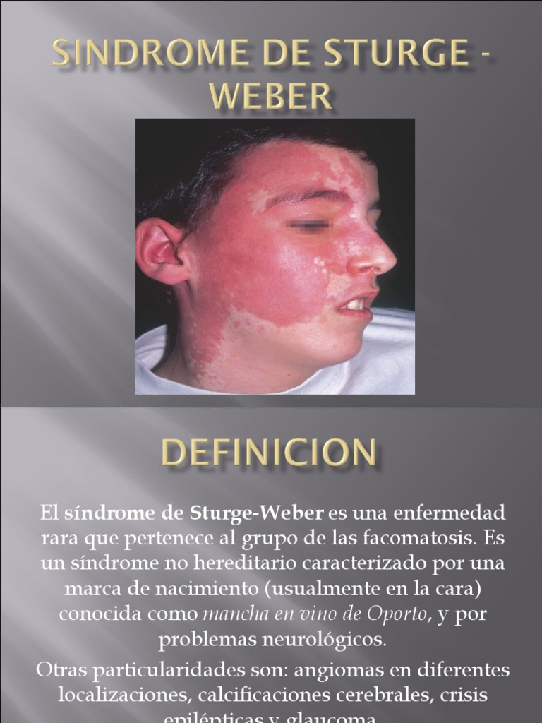 Sindrome de Sturge Weber PDF Enfermedades y trastornos Especialidades Medicas