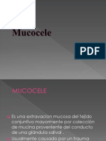 5mucocele