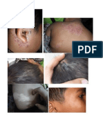 Impetigo Patofisiologi